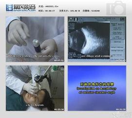 德国产妇针灸治疗视频,缓解分娩疼痛新选择